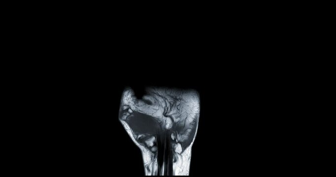 MRI hand coronal t1w for diagnosis bone arthritis and rheumatoid.