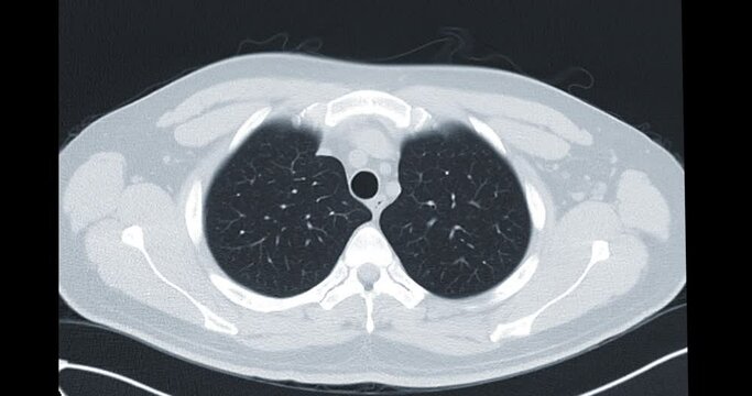 CT Chest or CT Lung axial mip view  for diagnostic lung diseases and covid-19.