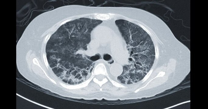 CT Chest or CT Lung axial mip view  showing lung after infected  covid-19 .
