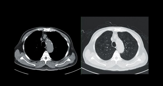 Compare of CT Chest or CT Lung axial view soft tissue and lung window  for diagnostic lung diseases and covid-19.