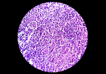 A histological slide of a tissue sample. Close microscopic view. Histopathology, Cytopathology (FNAC) fine needle aspiration cytology, Malignant cell