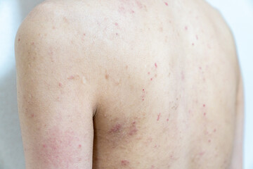 アトピー / あせも / 皮膚炎のイメージ。　肌荒れ男性の写真。