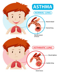 Asthma diagram with normal lung and asthmatic lung