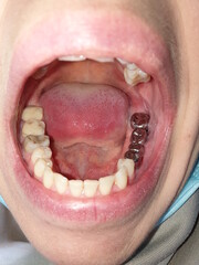 Obraz premium metal dentures in the mouth. dental prosthetics