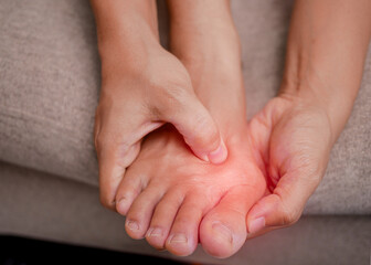 Closeup of female holding her painful feet and massaging her bunion toes to relieve pain. Swollen...