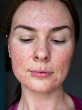 close-up of the skin of a patient with papulopustular rosacea, full face