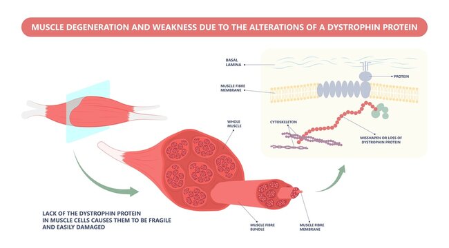 Muscle myopathy gene DNA cell damage Becker type Limb Girdle x linked Distal Emery loss Lack fibres tissue biceps arm spine weaken gait lumbar calf sign Gower lower exam fatigue Physical genetic stand