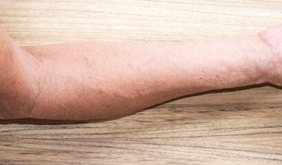 The skin on the arm of an elderly person with symptom of inflamed skin and a rash.