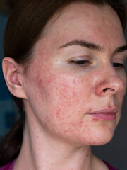 close-up of the skin of a patient with papulopustular rosacea