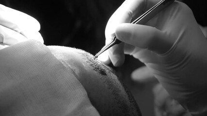 Close-up shot of hair transplantation procedure