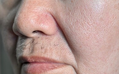 Enlarged pores in face of Asian, elder man with skin folds.