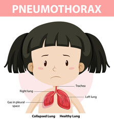 Pneumothorax diagram of human anatomy