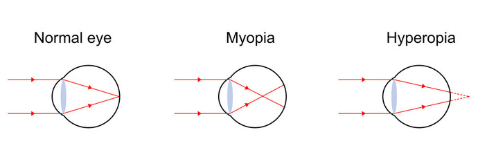 Illustration of light diagram on normal eye, myopia, and hyperopia. - obrazy, fototapety, plakaty