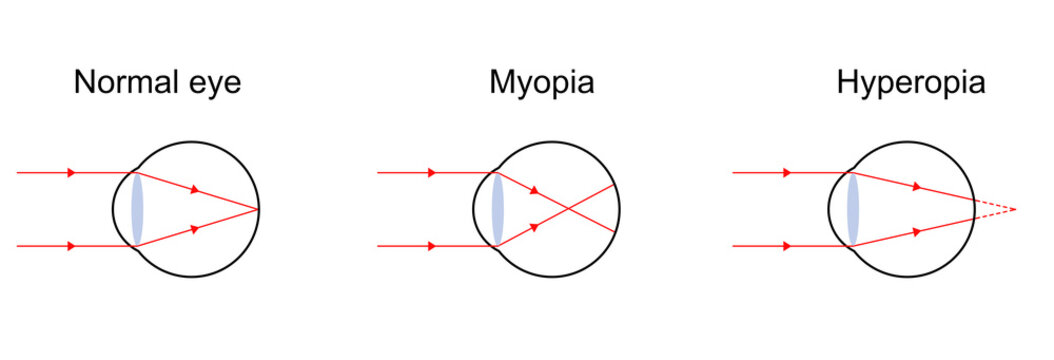 Illustration Of Light Diagram On Normal Eye, Myopia, And Hyperopia.