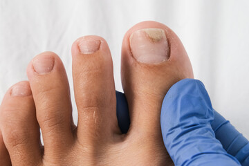 A podologist examines bare foot with onycholysis on a toenail after damaging with tight shoes or using gel-lacquer