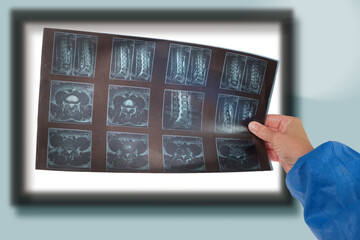 A doctor hands holding and analyzes spine radiography X-ray