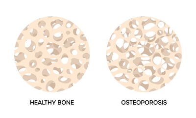 Healthy and osteoporosis bone, round illustrations on white background