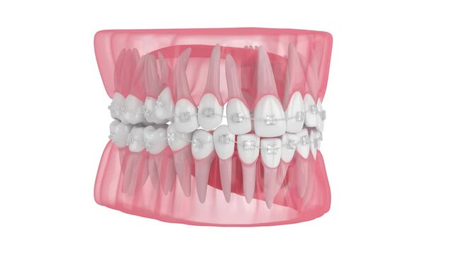 Teeth alignment by orthodontic clear ceramic braces isolated over white background