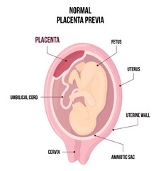 Fototapeta premium Normal Placental previa. Usual anatomical Placenta Location During Pregnancy.