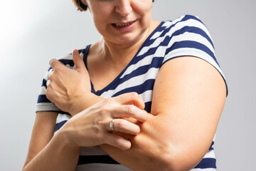 Woman scratching arm indoors, space for text. Allergy symptoms. People scratch the itch with hand, Arm, itching, Concept with Healthcare And Medicine.