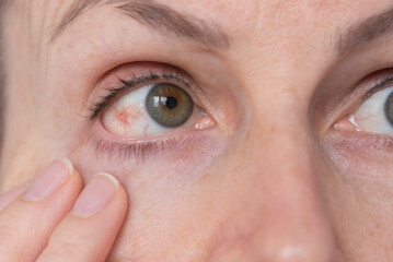 Reddened eye. Inflamed white of the eye. Burst capillaries. Overloading. Intracranial pressure,...