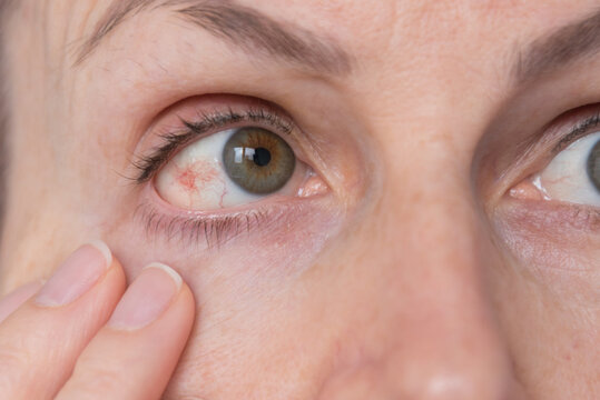 Reddened eye. Inflamed white of the eye. Burst capillaries. Overloading. Intracranial pressure, intraocular pressure