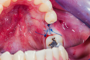 The gum is sutured with a special floss at the surgical incision to accommodate the dental implant.