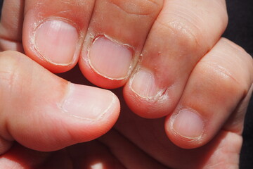 Closeup of deformed nails from human nail biting behavior Medical and healthcare concept