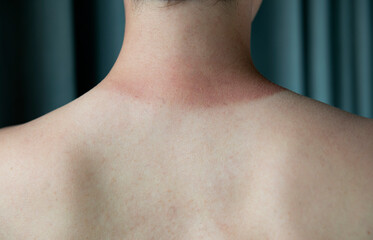 Harsh tan line formed from of a sunburn - back view