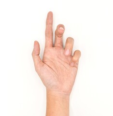 Ulnar claw hand of Asian young man. also known as 'spinster's claw.