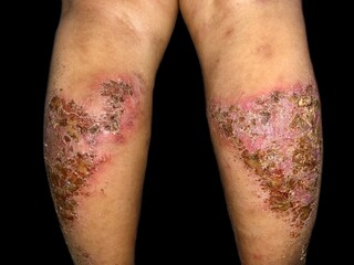 Dermatitis in both legs of Asian child