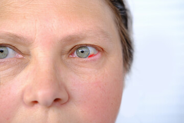 close up part of middle-aged woman's face 50-55 years old, human bruised eye, burst blood vessel,...