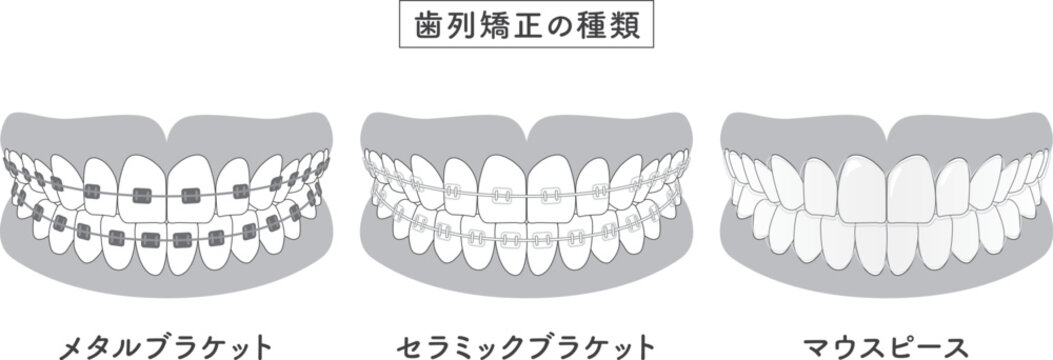 歯列矯正の種類　セットイラスト