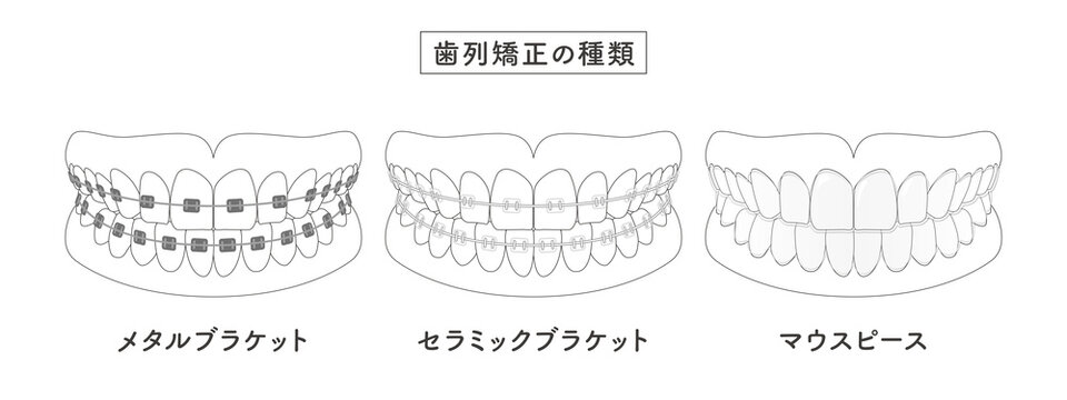 歯列矯正の種類　セットイラスト