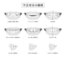 不正咬合の種類　セットイラスト © kogome