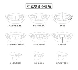 不正咬合の種類　セットイラスト