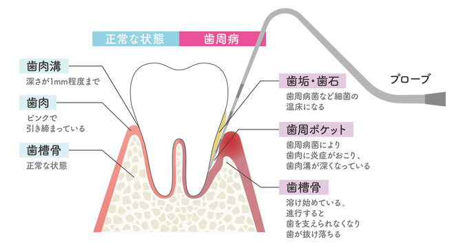 プローブで歯周病をチェックするイラスト
