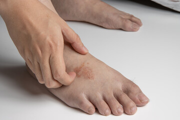hand scratching foot infected by ringworm, athlete's foot or tinea pedis fungal infection. on white...