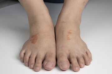 Fototapeta premium feet infected with ringworm, athlete's foot or tinea pedis fungal infection. on white background.