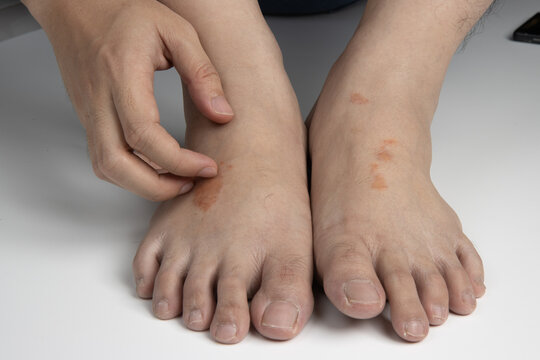 hand scratching foot infected by ringworm, athlete's foot or tinea pedis fungal infection. on white background.