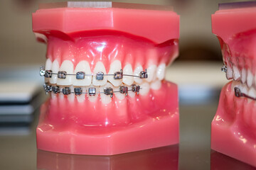 Orthodontic bracket or brace. Demonstration model of the teeth and braces. Braces on the jaw model....