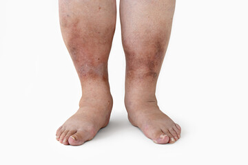 Swelling of the leg with inflammation in diabetic nephropathy in a woman, close-up. - obrazy, fototapety, plakaty
