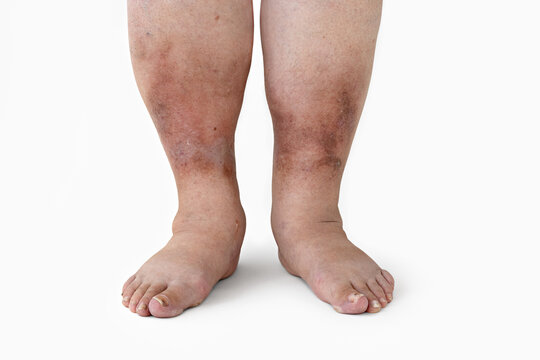 Swelling of the leg with inflammation in diabetic nephropathy in a woman, close-up.