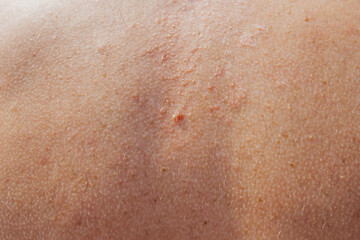 Fototapeta premium Seborrhea on the skin of the back - skin conditions treatment at a seaside resort - dry skin and inflammation