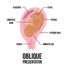 Fototapeta premium Latin arabian brown skin baby. Different wrong baby positions in uterus during pregnancy.