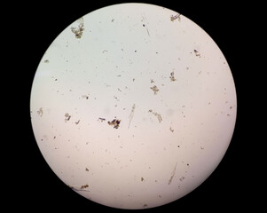 Schistosoma Haematobium Parasite in human urine specimen under microscope. Urinary parasite