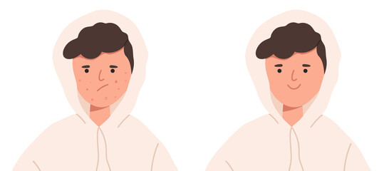 Fototapeta premium Teenage boy with acne before and after flat vector illustration isolated on white background. Set of male person with unhappy face with acne and happy clean skin.