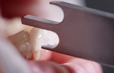 Close up of orthodontist using aluminum bracket gauge while attaching braces to patient teeth....