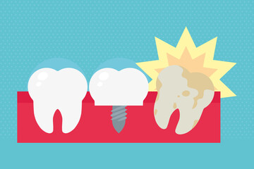 gum with implant illustration