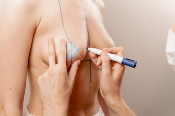 Doctor draws lines on chest with marker before plastic surgery. Breast augmentation surgery markup.
